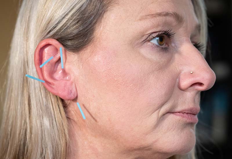 Akupunktur und Nadeln im Ohr